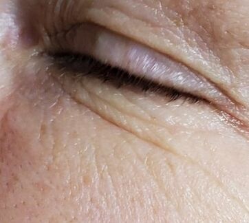 The skin became limp, my eyelids sagged through